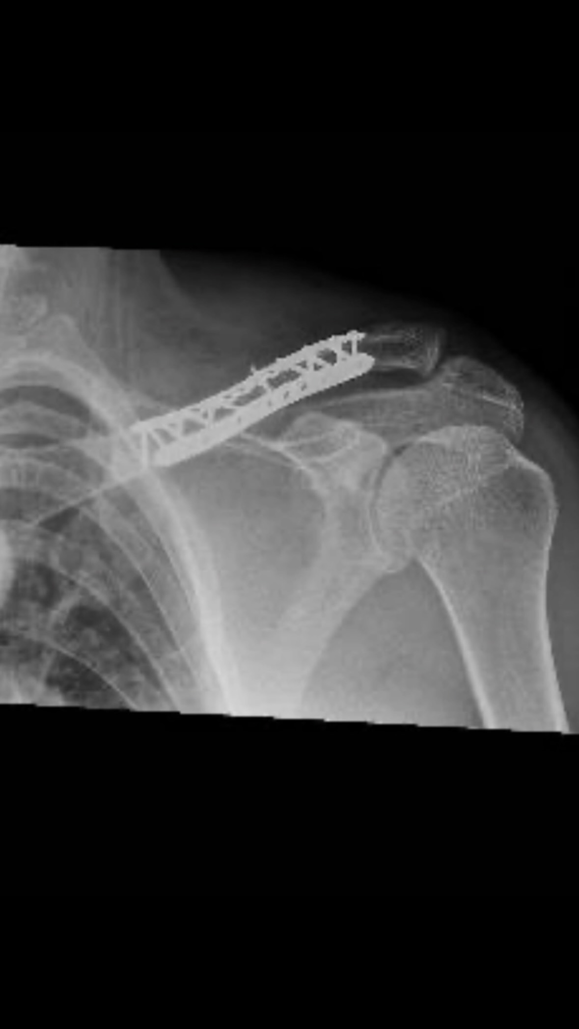 On June 20th I broke my collarbone at a practice ride/race for Leadville. Four days later I had surgery where they fixed my collarbone with two plates and 15 screws. Last week I got news that healing is going great and Leadville was a go again, only to be put on hold due to a wildfire threatening the town of Leadville and the surrounding areas.

Thanks to the amazing firefighters, the Willow fire has been contained enough they announced Leadville races will continue!

A rough seven weeks is nothing compared to what cancer survivors face every day. I chose this fight, they don’t get a choice. I will still be lining up for Leadville 100 MTB on August 15th not only to race but to finish strong.

Every dollar you give funds LIVESTRONG programs for people navigating cancer. Please donate to help a great cause.

#livestrong
#leadville100mtb