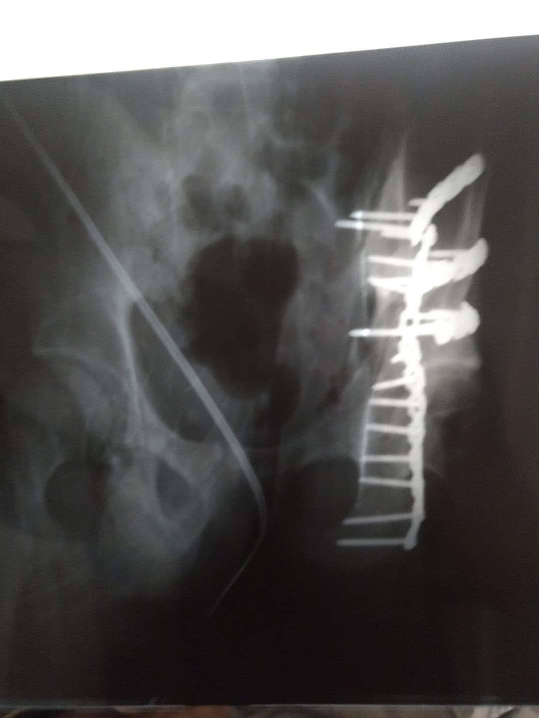 26 years ago I shattered my hip riding my dirt bike at Lake Elsinore MX in So California. Picture 1. I was able to get a lot of mileage before I needed an overhaul. Picture 2